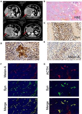 Adrenocorticotropic Hormone-Producing Paraganglioma With Low Plasma ACTH Level: A Case Report and Review of the Literature